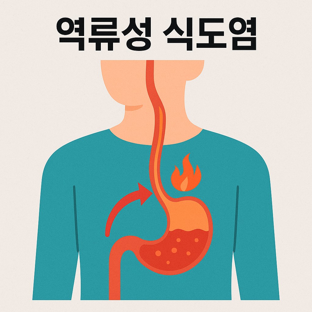 역류성 식도염