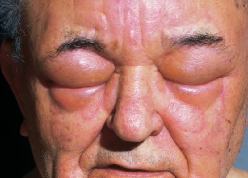 혈관부종이 발생했을 때 대처 방법