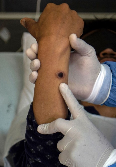 엠폭스 뜻 어떤 증상 및 원인 엠폭스 격리 및 예방접종