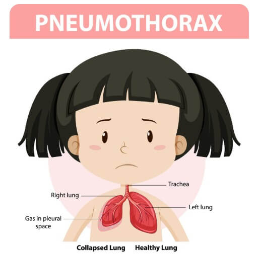 갑상선 기능 저하증의 원인