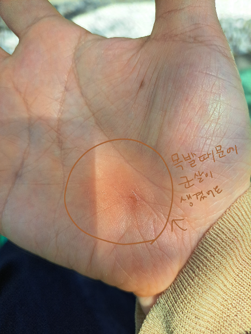 아킬레스건 파열 후기 4-무서운 계단, 운전은 언제부터? 그리고 근손실!