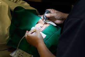 라식과 라섹 차이점