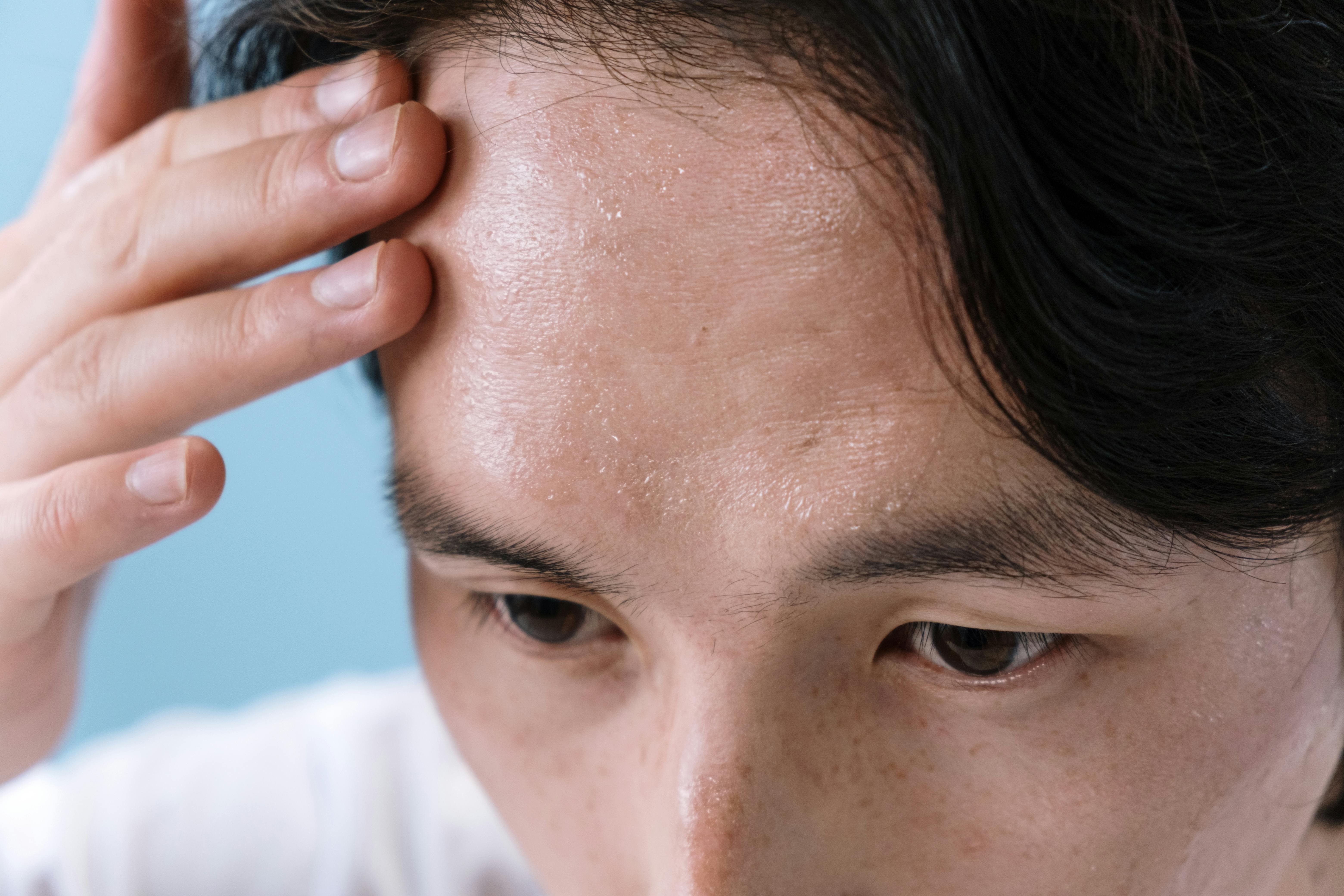 이마에 과도하게 흐르는 땀을 보고 놀라는 남성 – 다한증 증상 중 하나!
