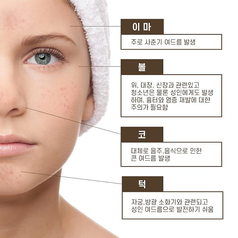 여드름 부위별 원인/ 출처 - 네이버포스트[파파웍스]