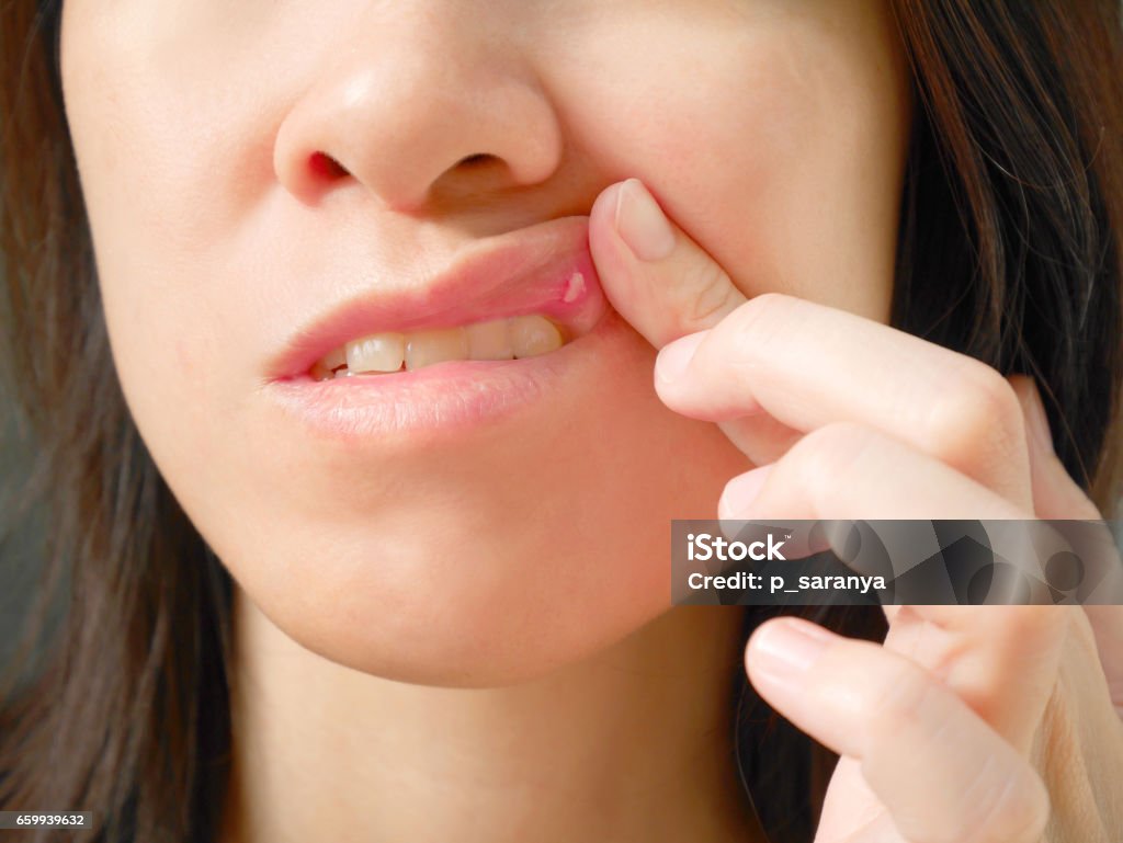 🔥 입 안이 찢어질 듯 아프다면? 지금 확인해야 할 구내염 증상과 대처법