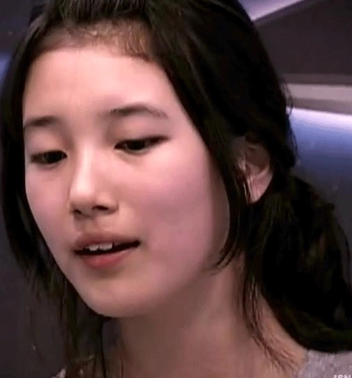 임플란트 후 교정 김태희 수지 효과 