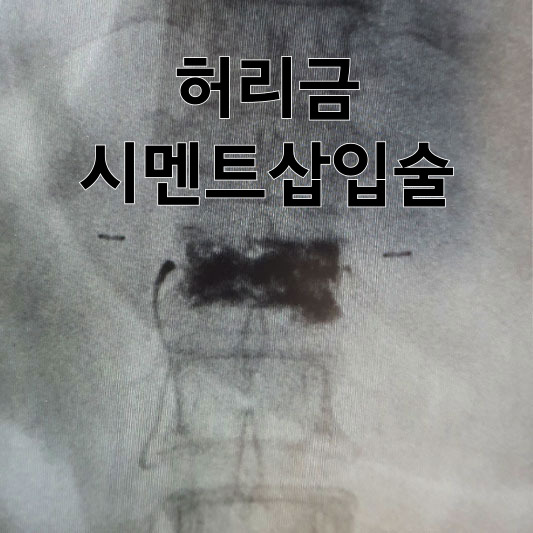허리금