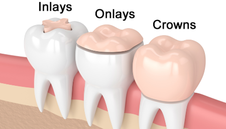 인레이 2차 충치 원인과 예방법