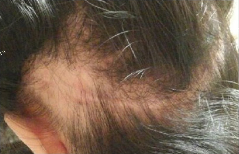모발이식 부작용 사례