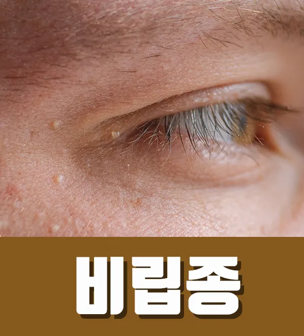 얼굴 비립종 없애는 법 자극 없이 제거하는 피부관리법_5