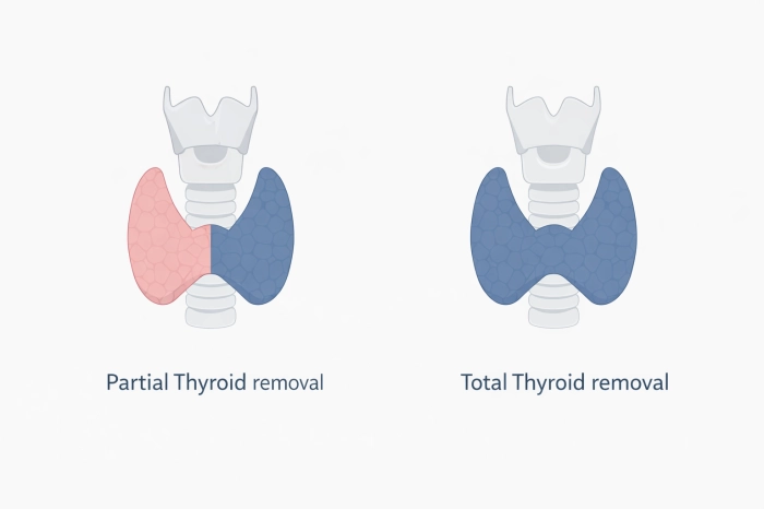 갑상선암 수술후 회복기간