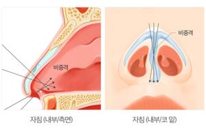 비중격 만곡증