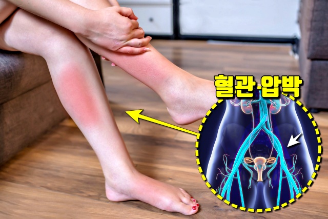 자궁 혹,자궁근종 증상 6,다리 붓기,팁줌