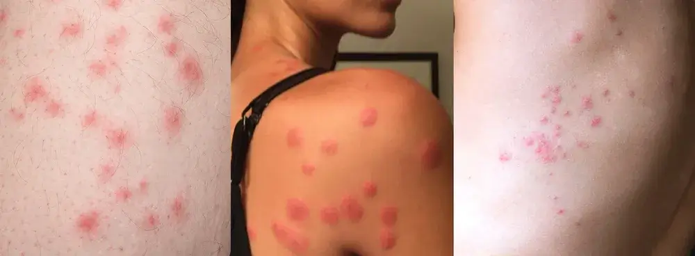 호텔방에 진드기 수십 마리&hellip;온 가족 병원 치료 호텔대처에 따른 대응방법