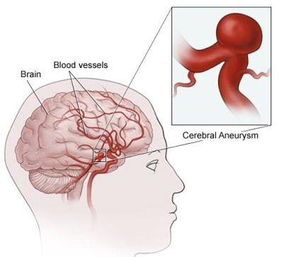 뇌동맥류 전조증상