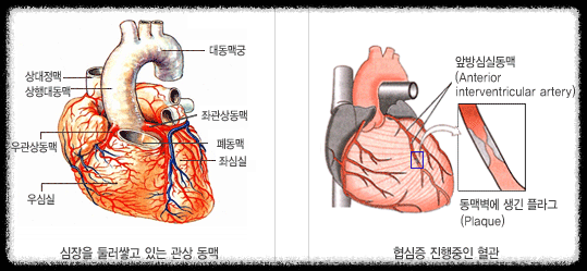 심장질환
