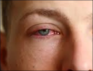 눈에 실핏줄이 터지는 이유-2