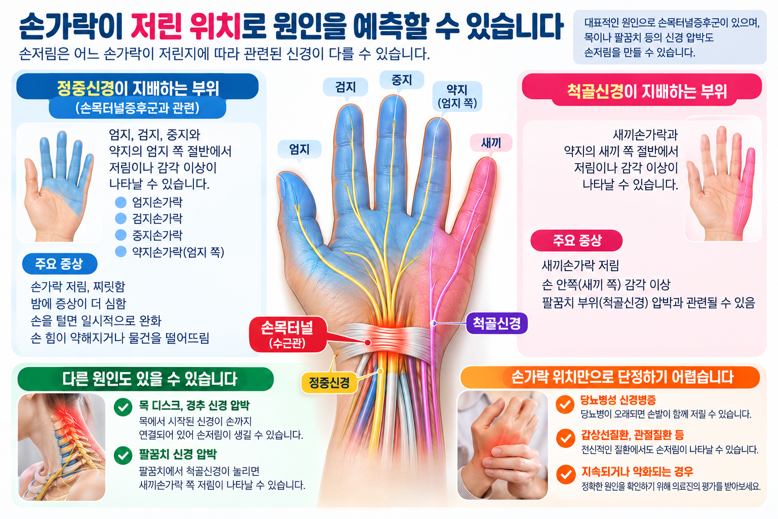 정중신경과 척골신경 관련 손가락 감각 영역을 비교한 도해