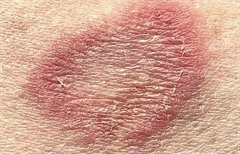 사타구니 백선 치료법 3가지 추천.