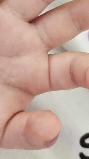 수족구병 증상 격리기간
