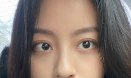 하안검 수술