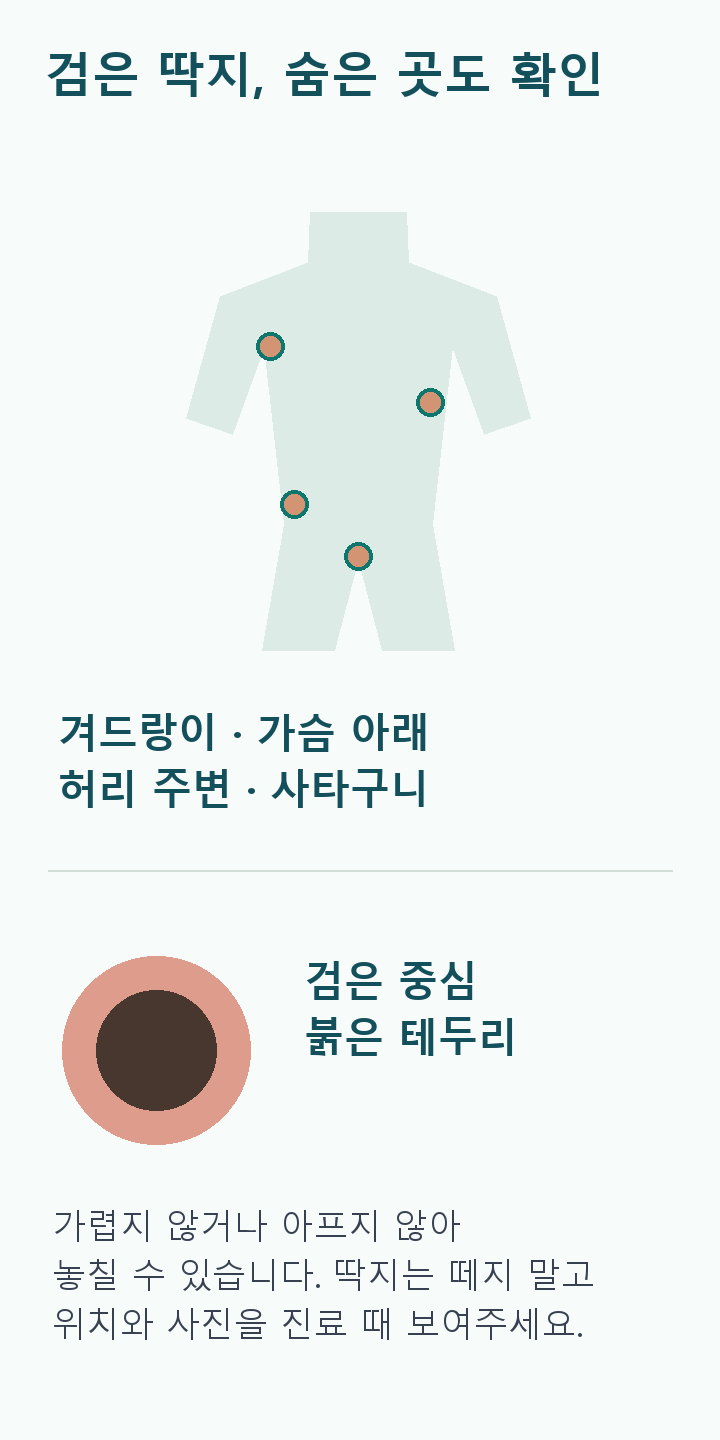 얼굴 없는 중립 몸통 도식에 겨드랑이&middot;가슴 아래&middot;허리&middot;사타구니 위치를 표시. 확대 피부 도식은 검은 중심과 붉은 테두리를 설명. 딱지는 떼지 않고 위치&middot;사진을 진료에 활용.