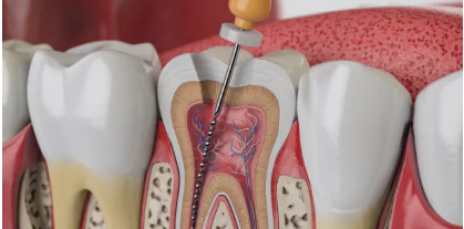 신경치료 모식도