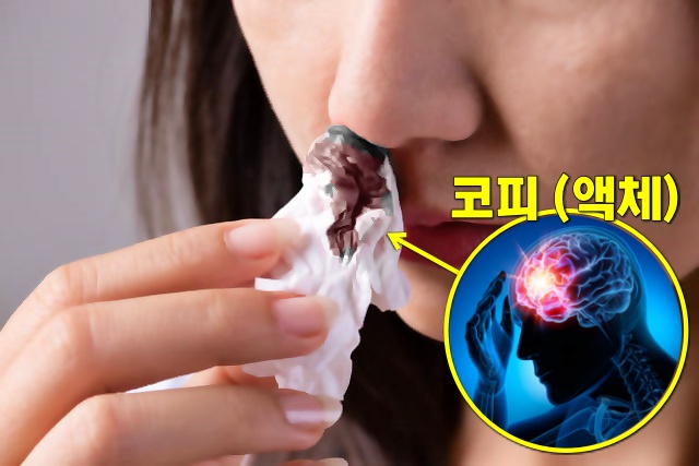 뇌진탕 초기증상 코피 맑은액체, 뇌진탕 증상, 건강 팁줌 매일꿀정보