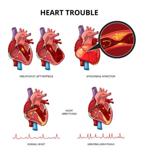  부정맥 원인인 혈관 찌꺼기 끼어 있는 모습 