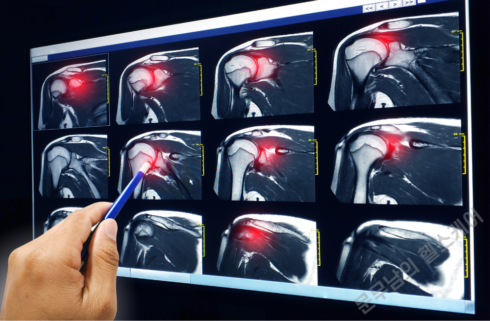 오십견 증상 원인 치료방법