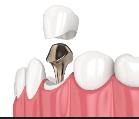 크라운치료-사진1