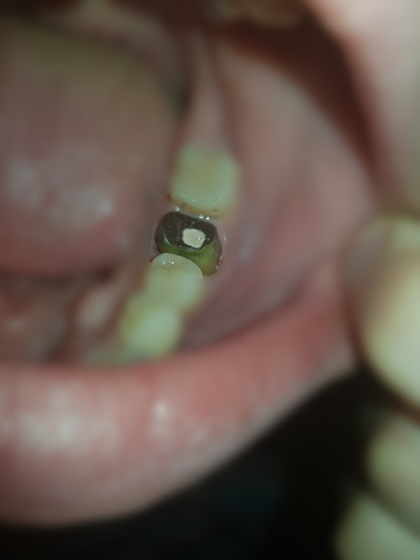 어금니-주조메탈포스트-기둥