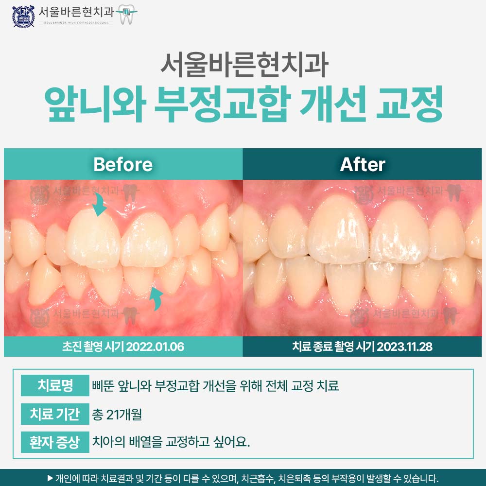 부산치아교정