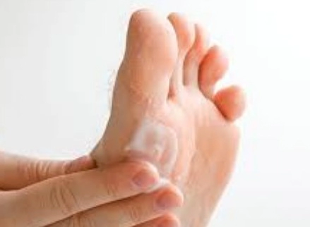 발무좀 없애는 방법