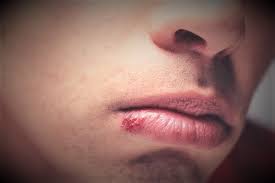 입술 포진 빨리 낫는법