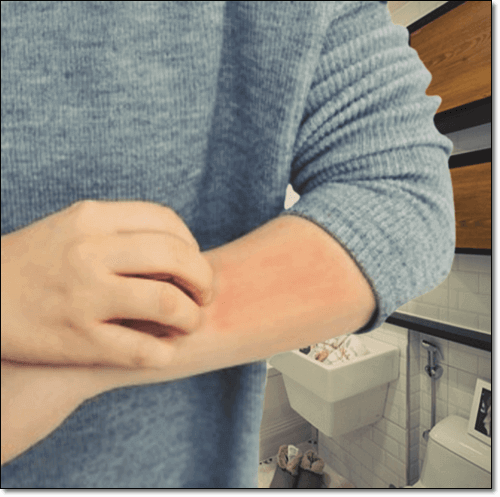 아토피 피부염 환자