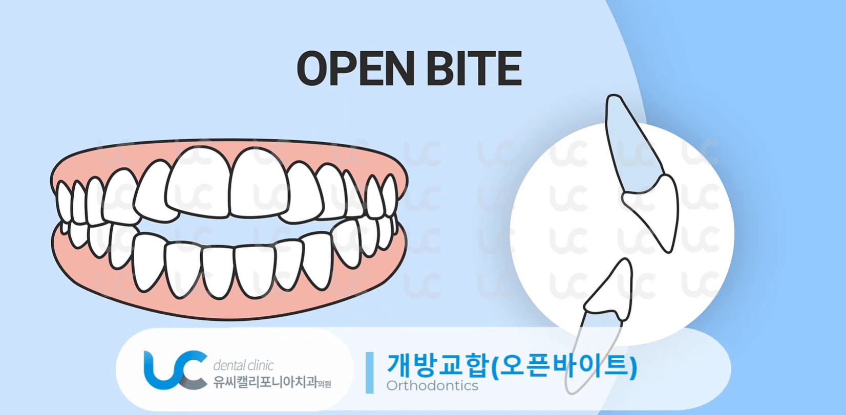 과개교합-치료-안하면