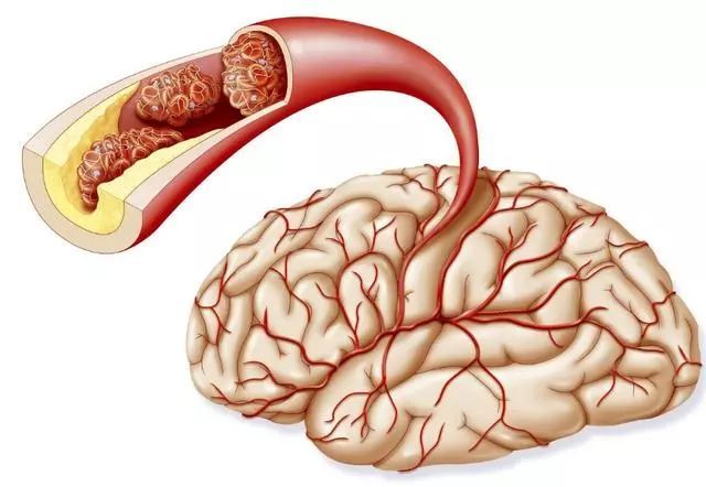 뇌혈관질환 전조증상