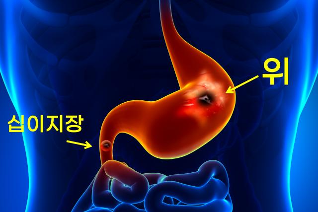 속이 쓰린 이유 속쓰림 원인 위궤양 십이지장궤양