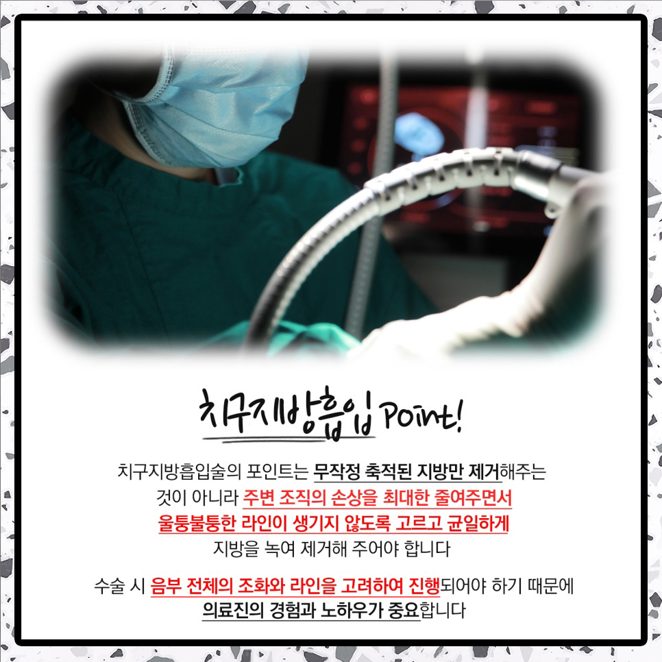 치구지방흡입 포인트