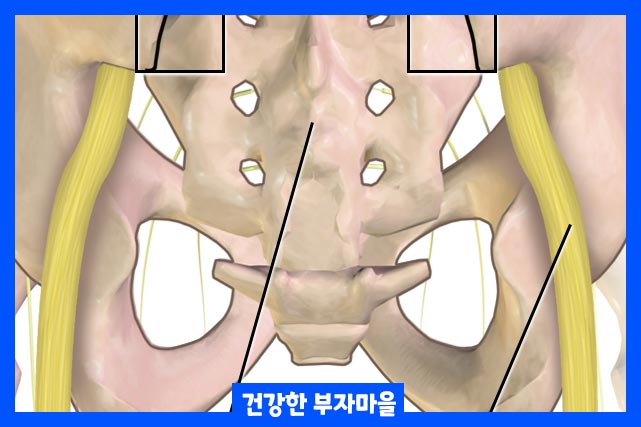 가정요법과 운동으로 엉치뼈 통증 완화