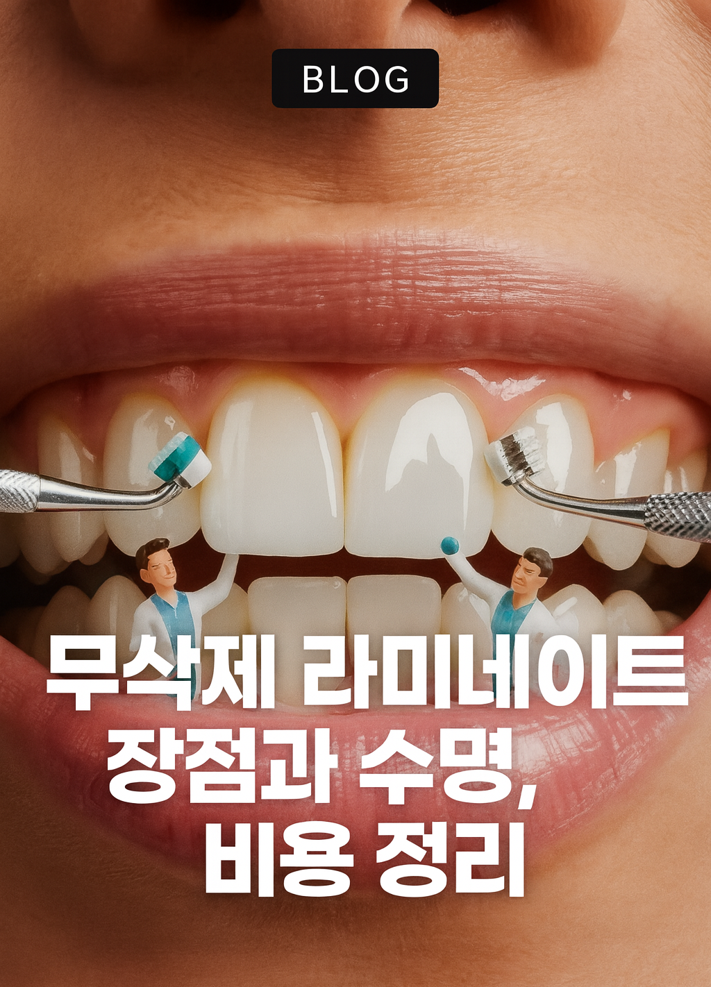 치아 라미네이트 가격