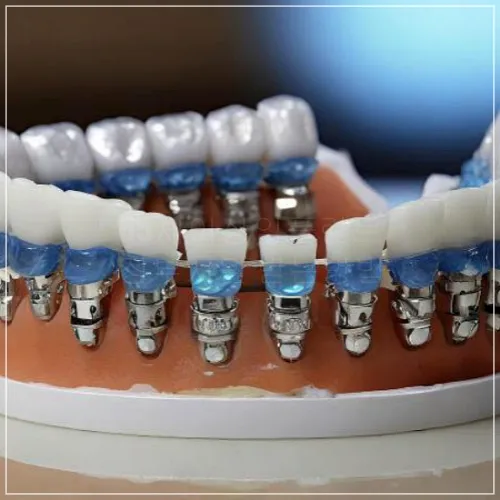  65세이상임플란트정부지원 받는방법2