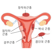 자궁근종 증상·원인·치료 방법, 여성 건강의 적신호