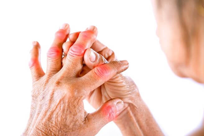 류마티스 관절염 초기증상