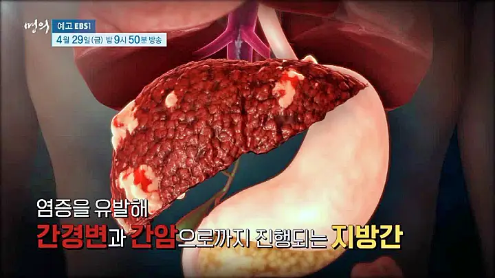 명의 지방간의 경고 저탄수 다이어트로 지방간 클리닉 탄수화물로 살찐 간이 위험하다