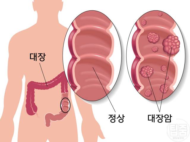 대추 매일 먹으면 3개 대추효능 대장암