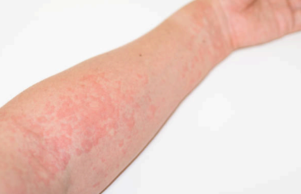 생선&middot;해산물 알레르기 체질 이미지사진