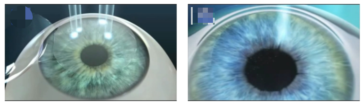 라식 라섹 차이점