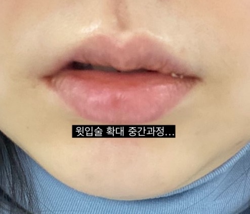 입술확대수술